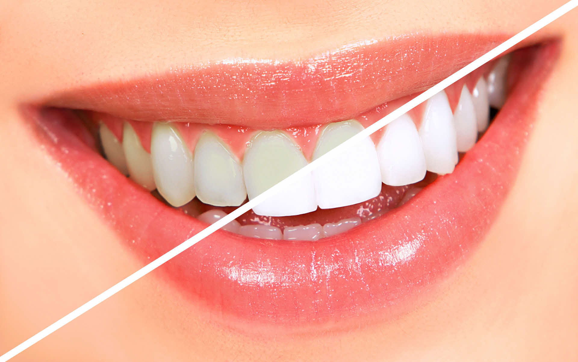 Fazer clareamento dentário antes ou depois do tratamento